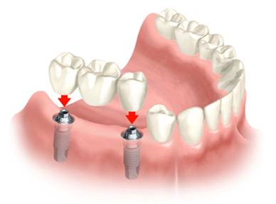 dental-implants-5