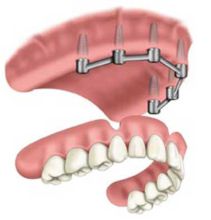dental-implants-6