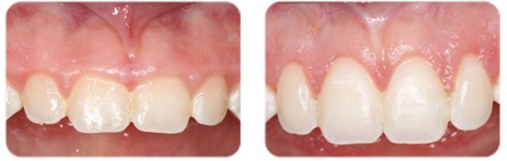 periodontal-3