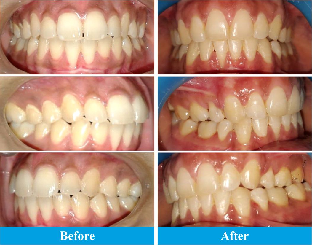 orthodontics-result-1