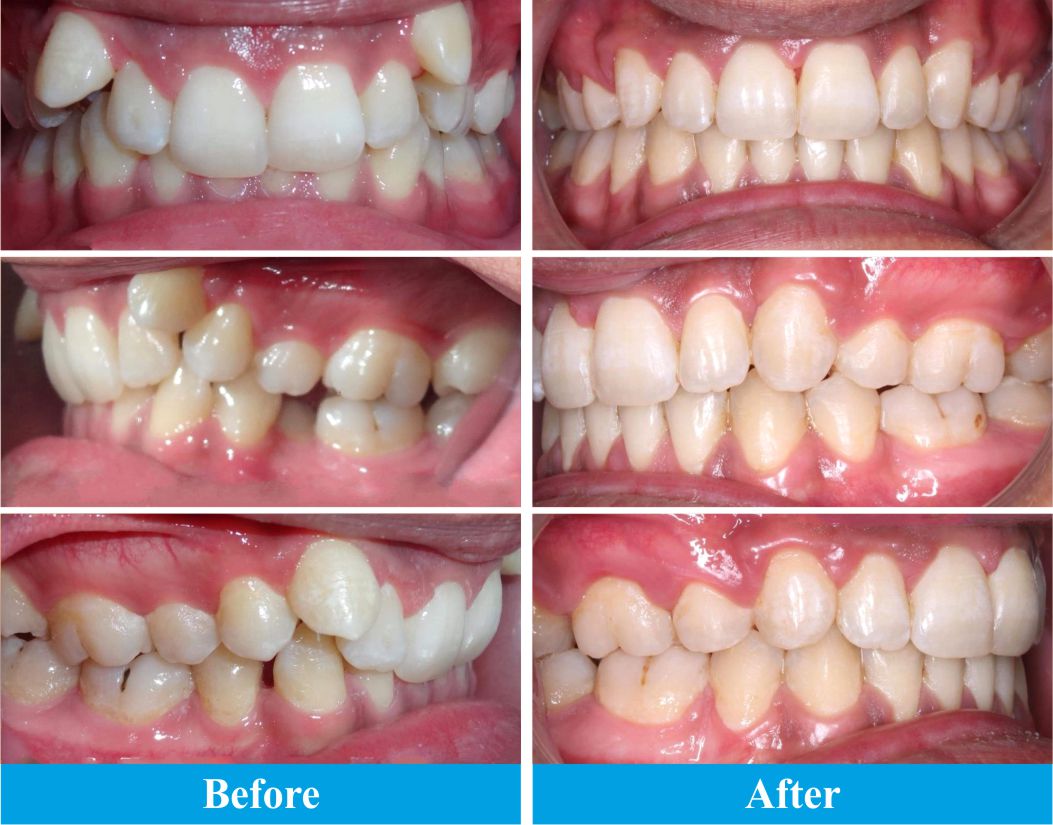 orthodontics-result-2