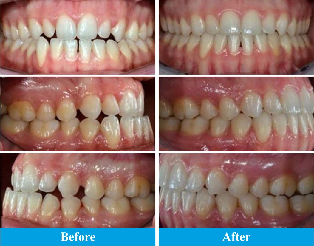 orthodontics-result-3