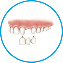 single-day-fixed-teeth-image