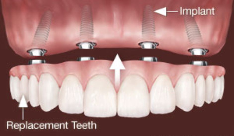 single-day-teeth-image